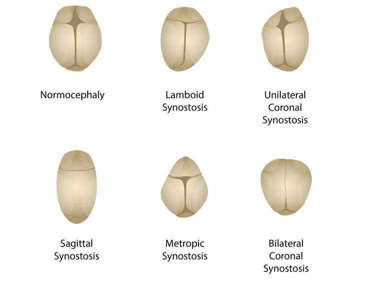 Craniosynostosis