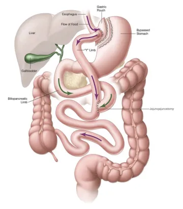 Gastric bypass
