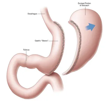 Sleeve gastrectomy