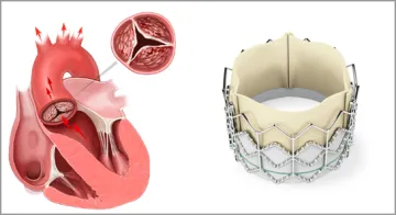 Transcatheter Aortic Valve Replacement (TAVR)
