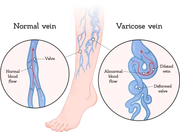 Varicose Vein