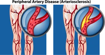 Peripheral Artery Disease