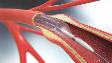 Stent implantation