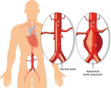 Abdominal Aorta Aneurysm