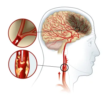 Carotid Artery Disease