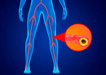 Ischemic disease of the lower extremities